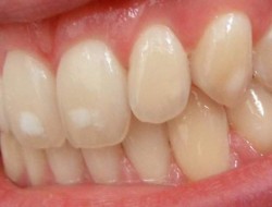 جرم‌گیری برای دندان مضر است؟
