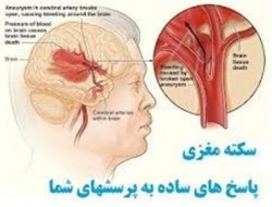 عواملی که باعث سکته مغزی می‌شود