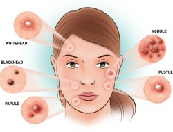 انواع آکنه و روش‌های درمانی آن